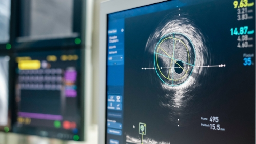Intravascular ultrasound imaging (IVUS) at Cath Lab